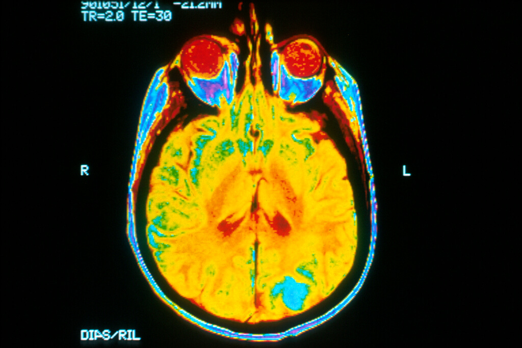 NCI Visuals Online - Brain MRI A single image of a human brain using a magnetic resonance imaging (MRI) machine. A bright blue color where brain cancer metastasizes in the occipital lobe.