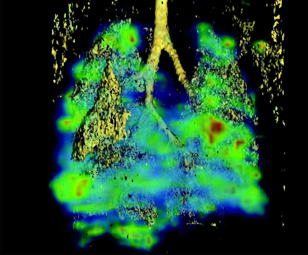 NCI Visuals Online Novel Multimodality Imaging Approaches to Target Metastatic Cancers